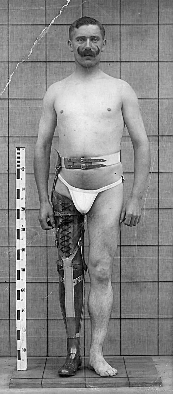 Historisches Foto eines fast unbekleideten, Unterschenkel-amputierten Soldaten aus dem Ersten Weltkrieg mit Lederprothese neben einer Messlatte stehend