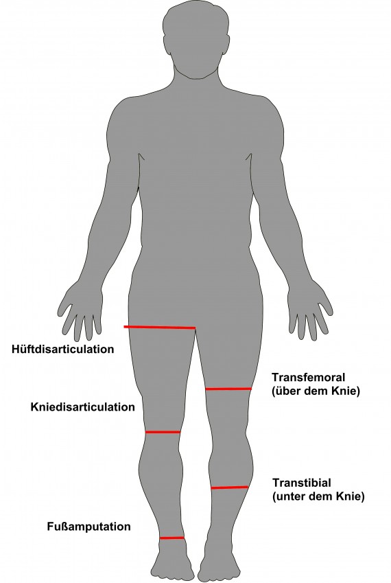 Schematisches Schaubild der verschiedenen Beinamputationsarten und deren medizinischen Bezeichnungen