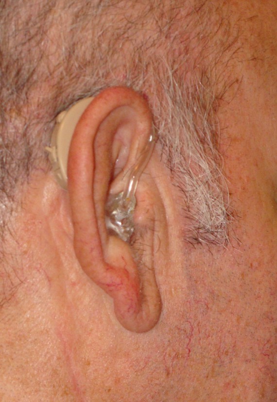 Detailansicht eines angelegten Hinter-dem-Ohr Hörgeräts im Gebrauchseinsatz an einem rechten Ohr eines älteren Mannes